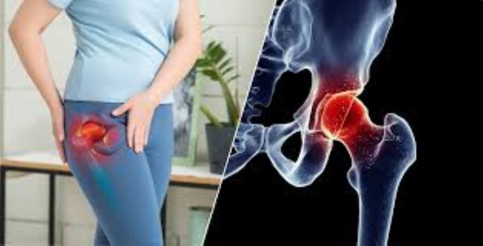 Post-COVID Rise in Hip Arthritis & AVN in India